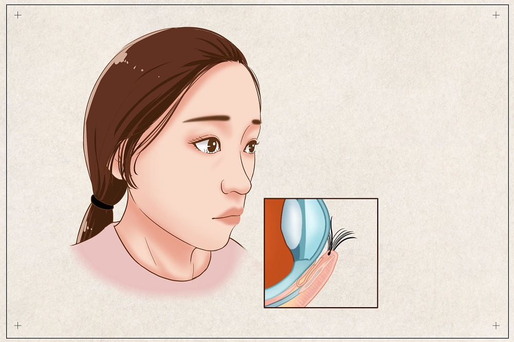 倒睫會(huì)自己好嗎？